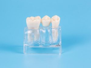 dental crowns