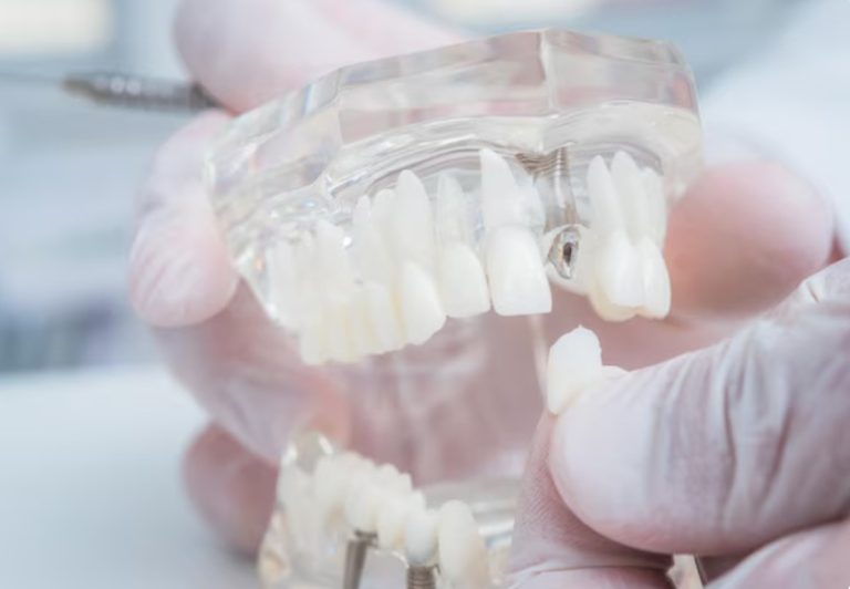 The orthodontist holds a model of teeth with implants